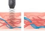 Shockwave Treatment in Milton